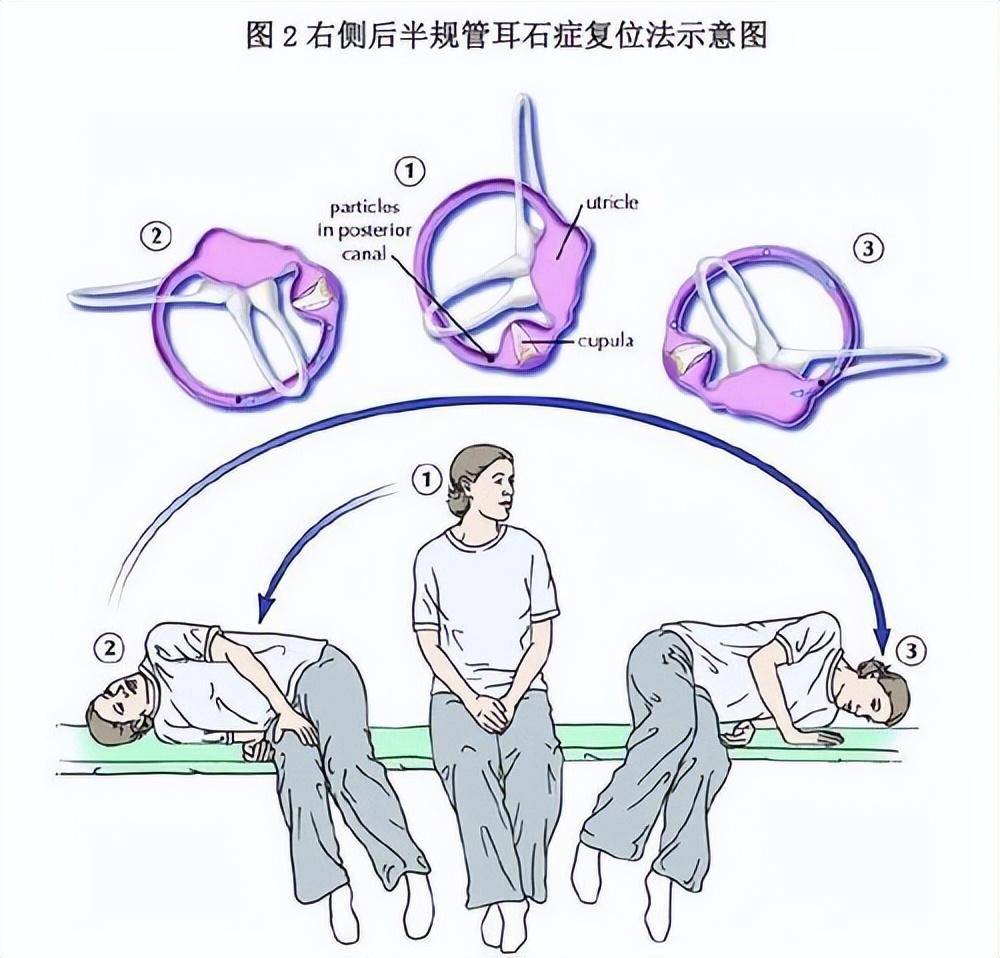 耳石復(fù)位最新技術(shù)探索，現(xiàn)代治療耳石癥的新進(jìn)展